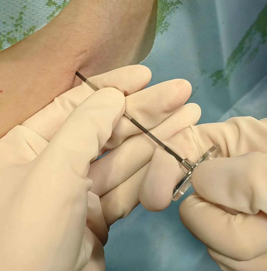 怎么知道穿刺到硬膜外硬膜外穿刺针需要略加改进_https://www.jmylbn.com_新闻资讯_第6张