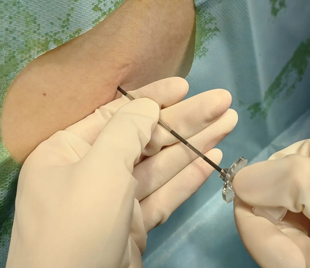 怎么知道穿刺到硬膜外硬膜外穿刺针需要略加改进_https://www.jmylbn.com_新闻资讯_第5张