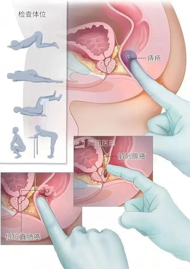 检查指套怎么弄肛门指检，到底有痛不痛？可么在家自行做么？_https://www.jmylbn.com_新闻资讯_第5张