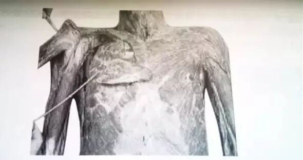 外展枕怎么使用干货 ｜ 针刀治疗要点规程定点定位_https://www.jmylbn.com_新闻资讯_第25张