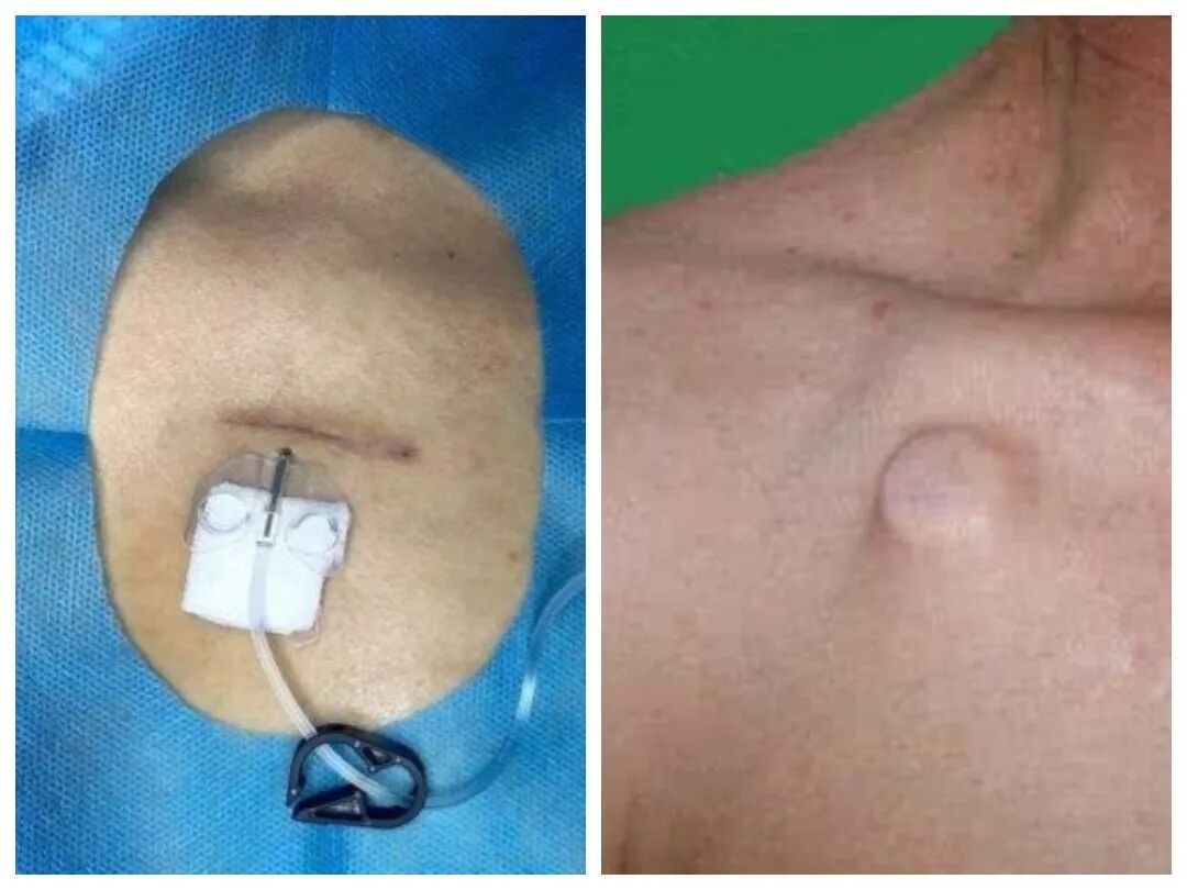 加压输液什么意思输液港：肿瘤、长期输液患者的“幸福港湾”——榆林市中医医院开展胸壁输液港植入术_https://www.jmylbn.com_新闻资讯_第2张