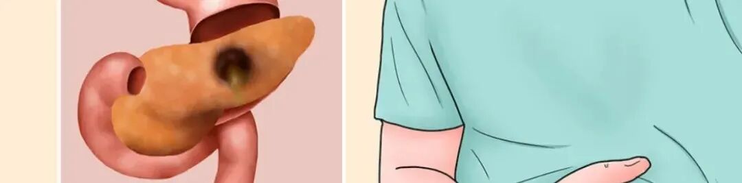 kielland产钳怎么翻译近乎失传的高难度产钳术，产科成功实施并实现“零痕迹”助产_https://www.jmylbn.com_新闻资讯_第9张