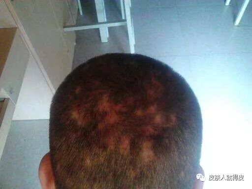 伴永久的脱发的毛囊炎