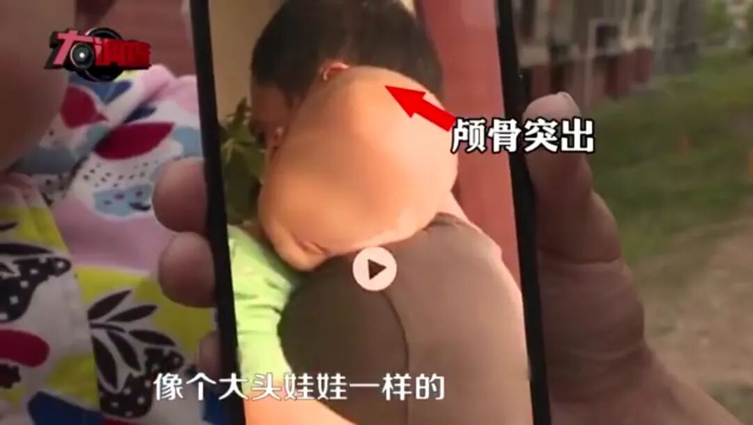 跃入了大众的视线——湖南郴州永兴县,多位家长发现自己宝宝头骨突出