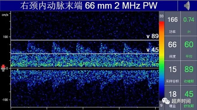 TCD怎么切换探头TCD：经颅多普勒(1-2)：基础知识、检查操作_https://www.jmylbn.com_新闻资讯_第9张