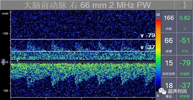 TCD怎么切换探头TCD：经颅多普勒(1-2)：基础知识、检查操作_https://www.jmylbn.com_新闻资讯_第8张