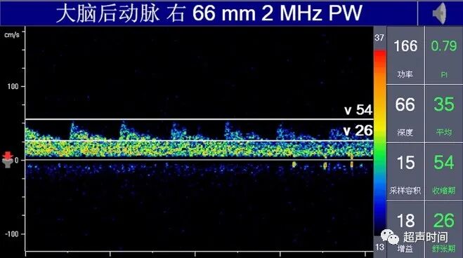 TCD怎么切换探头TCD：经颅多普勒(1-2)：基础知识、检查操作_https://www.jmylbn.com_新闻资讯_第10张