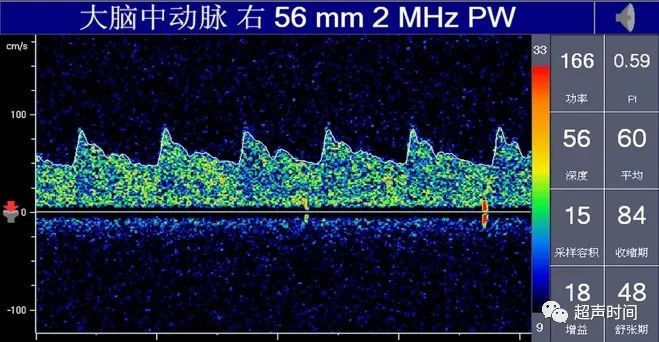 TCD怎么切换探头TCD：经颅多普勒(1-2)：基础知识、检查操作_https://www.jmylbn.com_新闻资讯_第7张