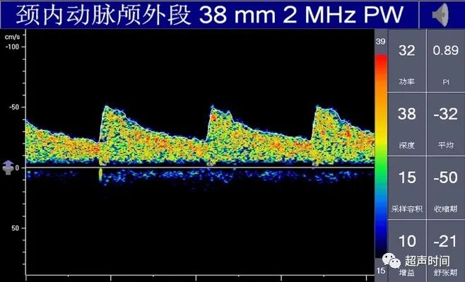 TCD怎么切换探头TCD：经颅多普勒(1-2)：基础知识、检查操作_https://www.jmylbn.com_新闻资讯_第18张