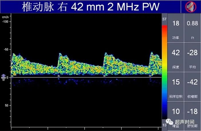 TCD怎么切换探头TCD：经颅多普勒(1-2)：基础知识、检查操作_https://www.jmylbn.com_新闻资讯_第16张