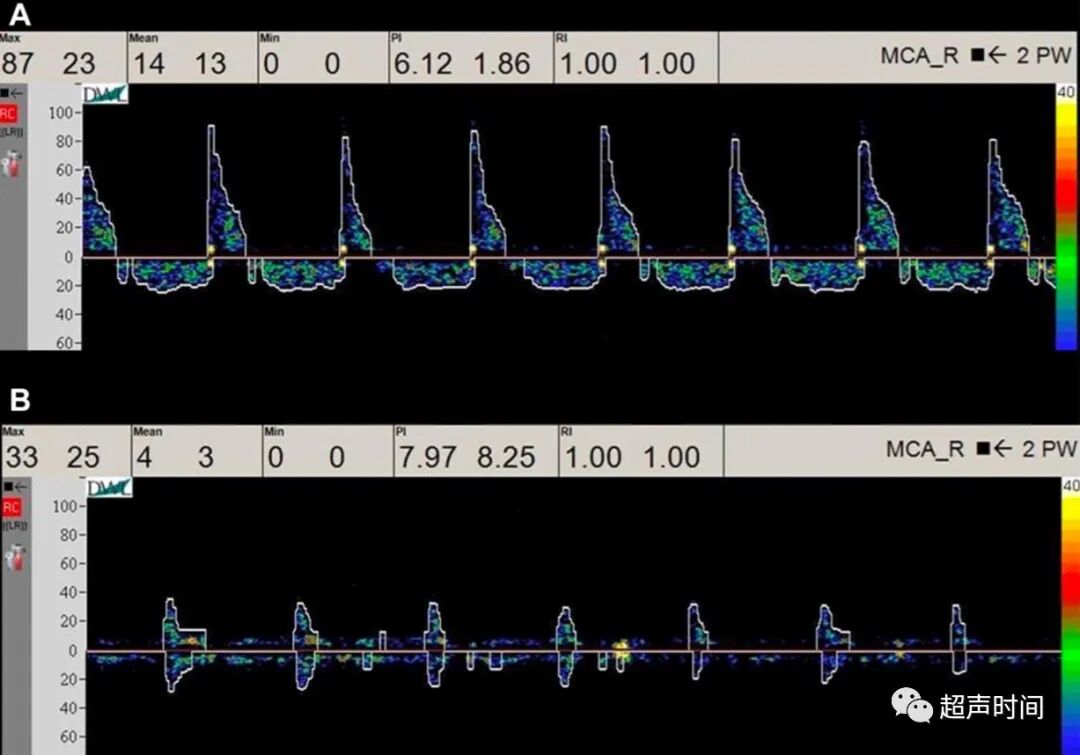 TCD怎么切换探头【血管超声】经颅多普勒（TCD）基础知识及临床应用_https://www.jmylbn.com_新闻资讯_第39张