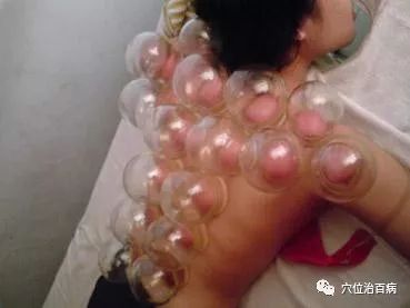 拔罐，胜过吃药！！
