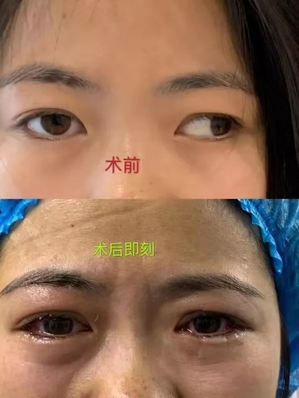 眼科手术 孩子斜视如何矫正