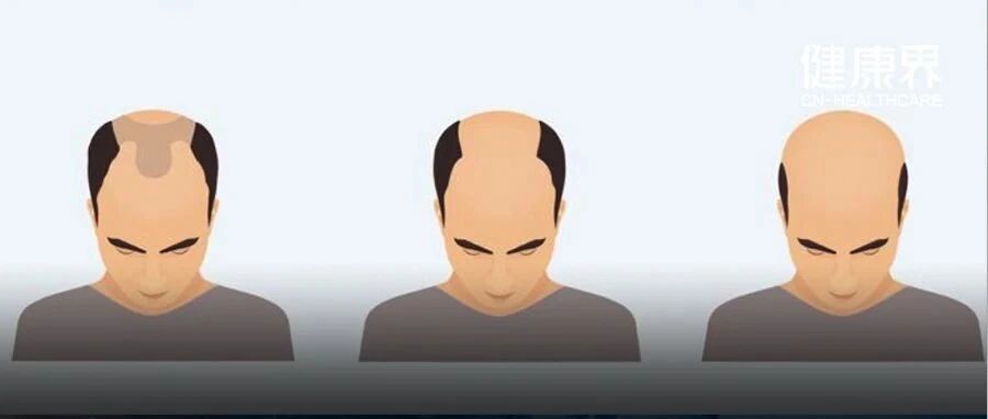 医生秃顶算工伤？研究称干细胞或成脱发「特效药」