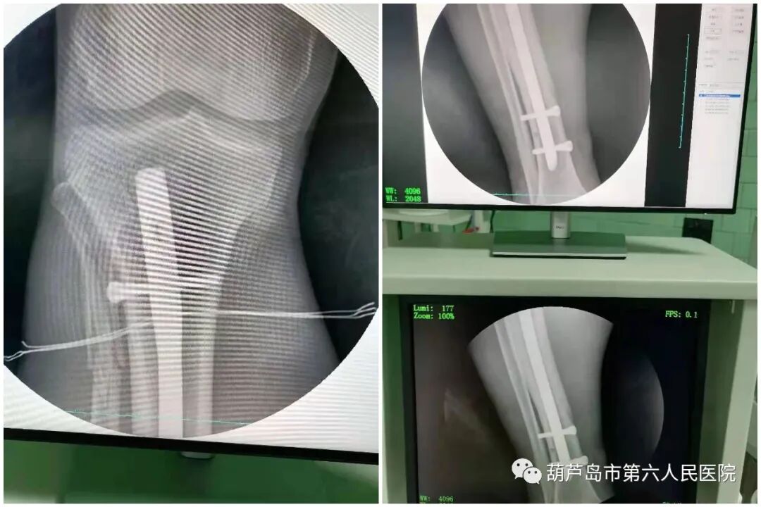c射线是什么“骨科医生的第三只眼”——高频移动式C型臂X射线机在六院正式投入使用！_https://www.jmylbn.com_新闻资讯_第4张