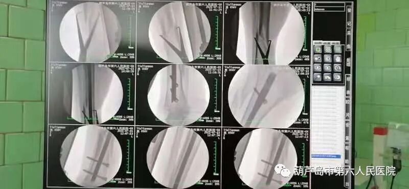 c射线是什么“骨科医生的第三只眼”——高频移动式C型臂X射线机在六院正式投入使用！_https://www.jmylbn.com_新闻资讯_第3张