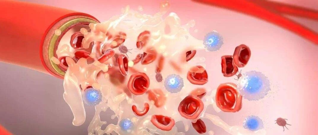 年轻女性“中风”  勿忘查查血管