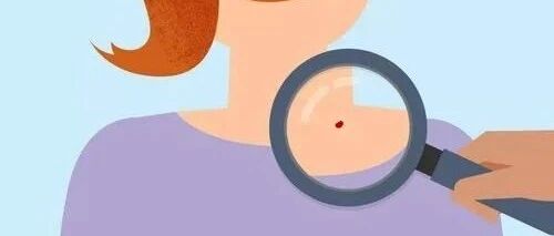 “血痣”是肝胆病变的前兆吗？