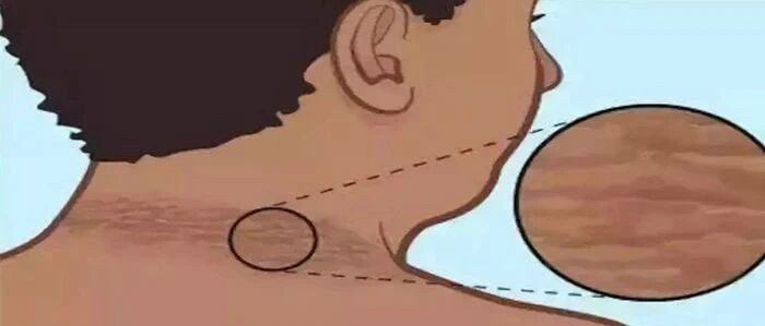 【11·14 联合国糖尿病日】脖子变黑是糖尿病的征兆吗？