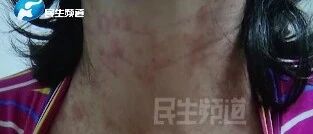 郑州一女子吃消炎药后全身过敏，家属：医院都抢救3次了！