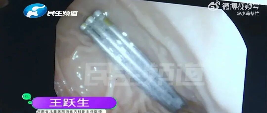 心疼！1岁婴儿胃里竟然有3根6cm钢钉...