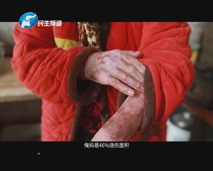 女子双腿被严重烧伤去抢救时一句话众人落泪