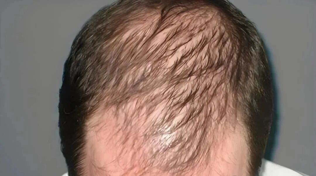 脂溢性脱发，是看中医还是看西医效果好？皮肤科医生一次给你讲明白，赶紧收藏