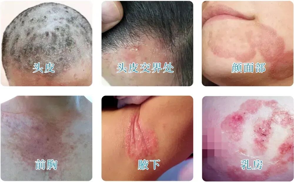 脂溢性皮炎冬季加重，这是什么原因？脂溢性皮炎发病机制是什么，平常如何防治