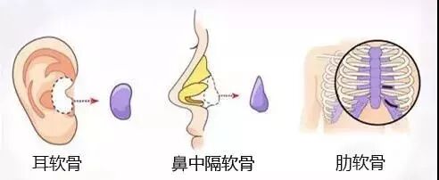 自体软骨隆鼻到底好不好 整形美容李芸医生 微信公众号文章阅读 Wemp