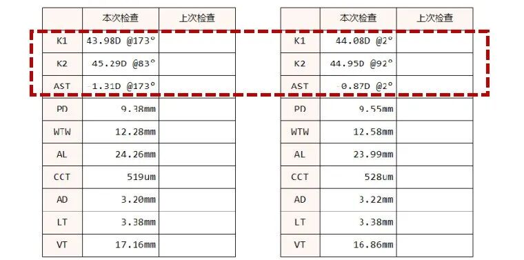 怎么测角膜直径一文教你看懂眼轴（光学生物测量）报告！_https://www.jmylbn.com_新闻资讯_第10张