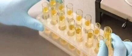 看病总要先查尿，尿常规能查出哪些疾病？