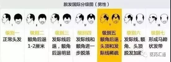 每天掉發多少根算正常？超過這個數，千萬要警惕！ 健康 第13張