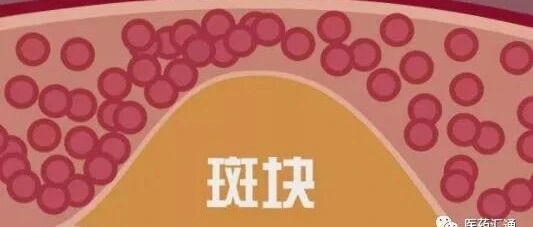 身体出现这些表现，当心血脂偏高了！看看这些调控妙招