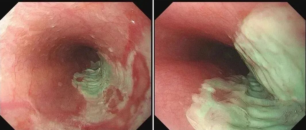 BE药片治什么作用触目惊心！食道被药片“割烂”！这几个服药习惯害了太多人！_https://www.jmylbn.com_新闻资讯_第7张