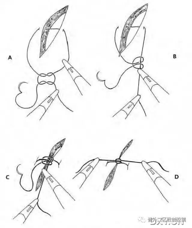 缝线怎么打结腹腔镜打结的技巧_https://www.jmylbn.com_新闻资讯_第8张