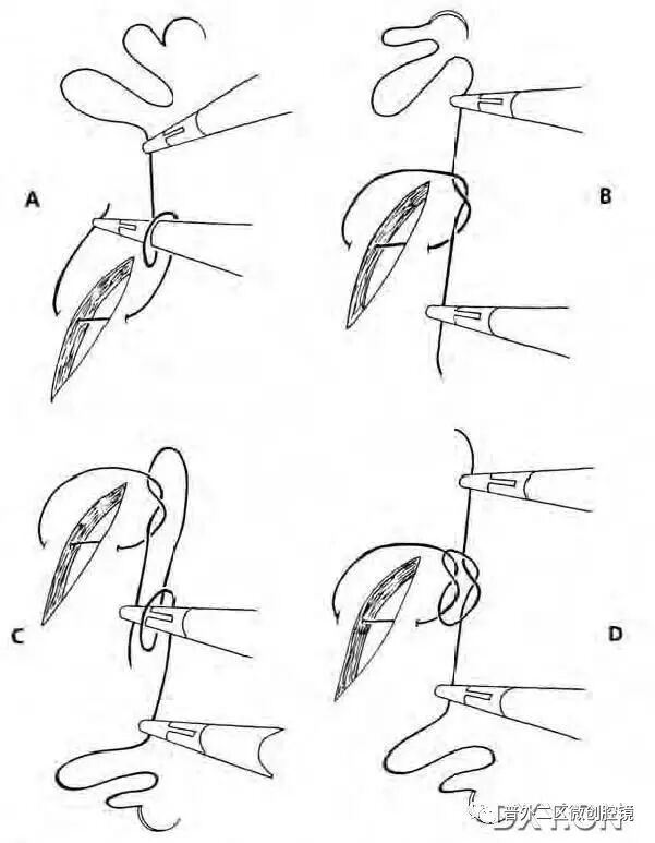 缝线怎么打结腹腔镜打结的技巧_https://www.jmylbn.com_新闻资讯_第9张