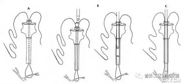 缝线怎么打结腹腔镜打结的技巧_https://www.jmylbn.com_新闻资讯_第7张