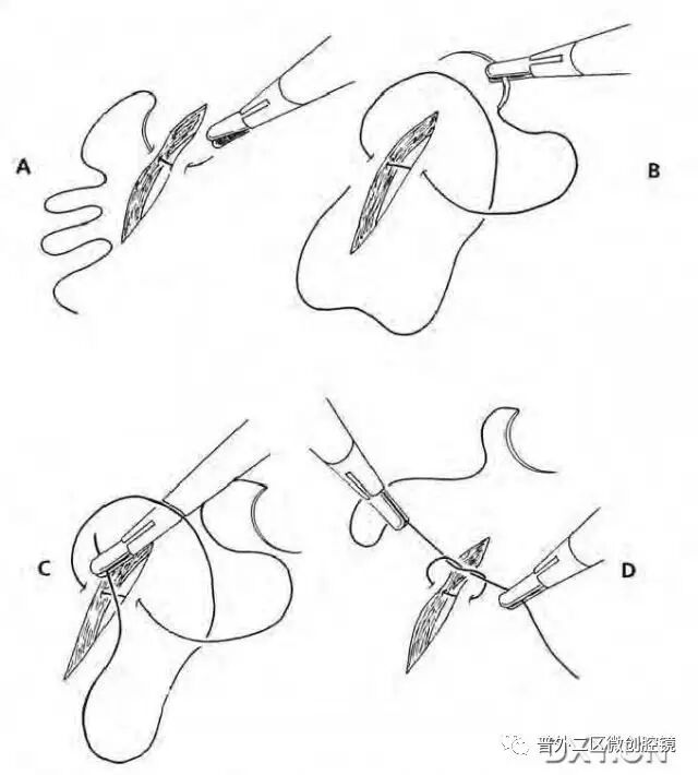 缝线怎么打结腹腔镜打结的技巧_https://www.jmylbn.com_新闻资讯_第10张