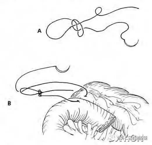 缝线怎么打结腹腔镜打结的技巧_https://www.jmylbn.com_新闻资讯_第12张