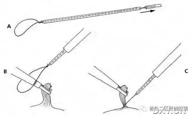 缝线怎么打结腹腔镜打结的技巧_https://www.jmylbn.com_新闻资讯_第5张