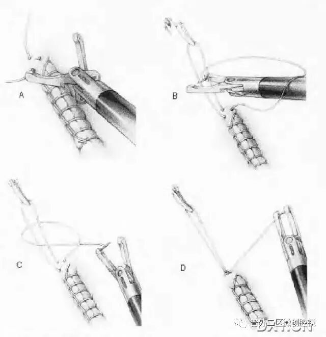 缝线怎么打结腹腔镜打结的技巧_https://www.jmylbn.com_新闻资讯_第11张