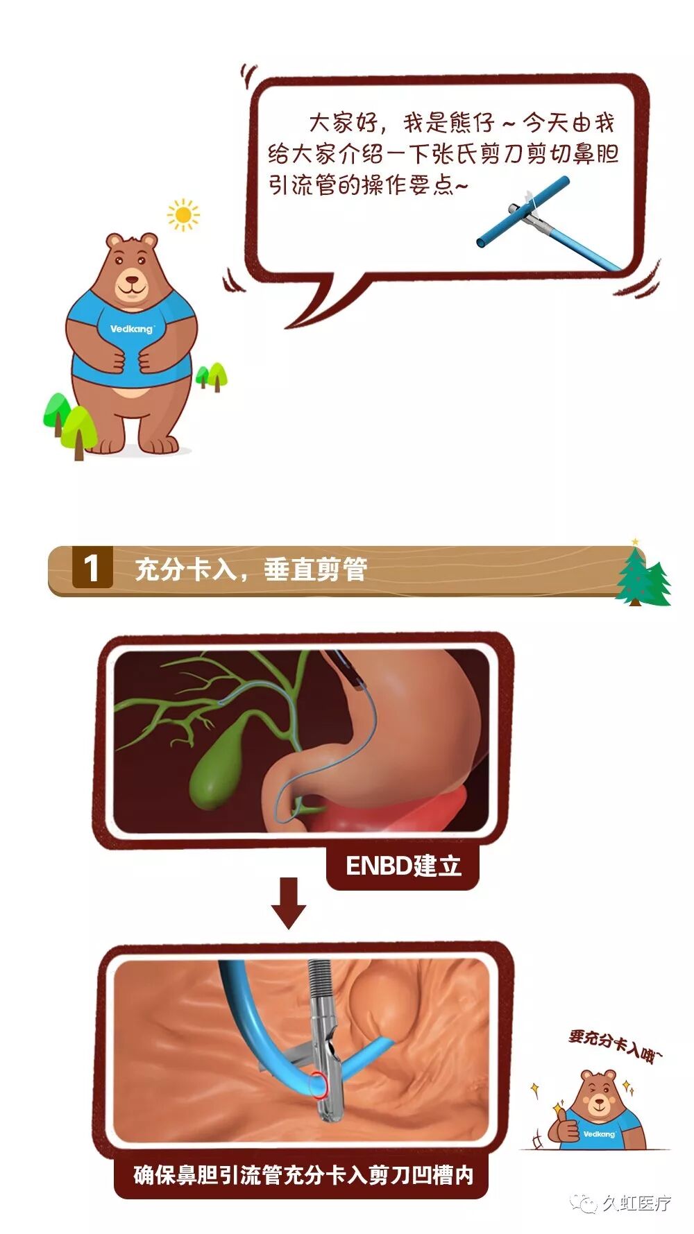 肝门部狭窄引流新方法 Enbd修剪要点 久虹医疗 微信公众号文章阅读 Wemp