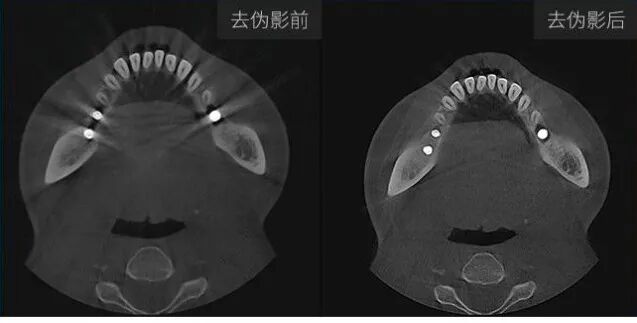 口腔ct什么牌子好【好物分享】口腔CBCT视野到底重不重要？多大视野最合适？_https://www.jmylbn.com_新闻资讯_第9张