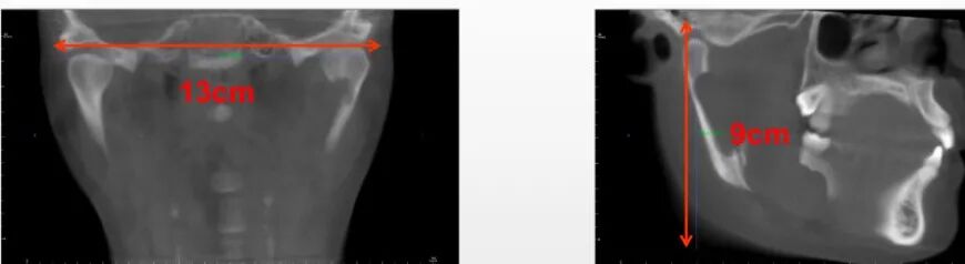 口腔ct什么牌子好【好物分享】口腔CBCT视野到底重不重要？多大视野最合适？_https://www.jmylbn.com_新闻资讯_第12张