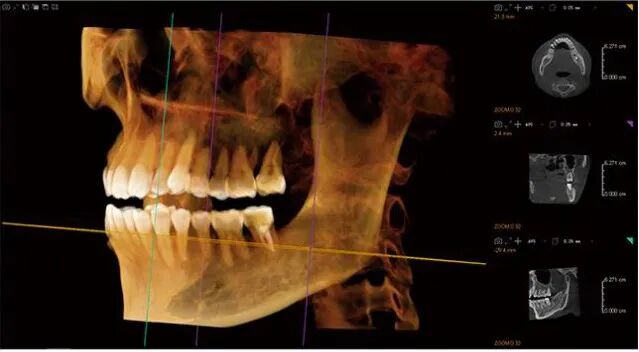 口腔ct什么牌子好【好物分享】口腔CBCT视野到底重不重要？多大视野最合适？_https://www.jmylbn.com_新闻资讯_第10张