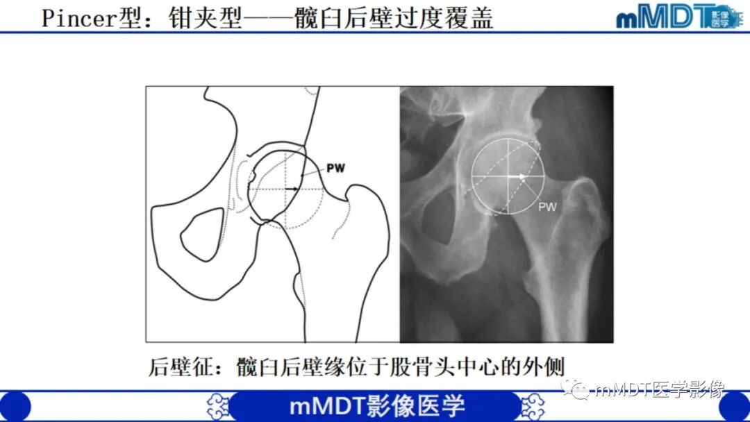 mmd在医学上什么意思股骨髋臼撞击症影像学改变_https://www.jmylbn.com_新闻资讯_第23张