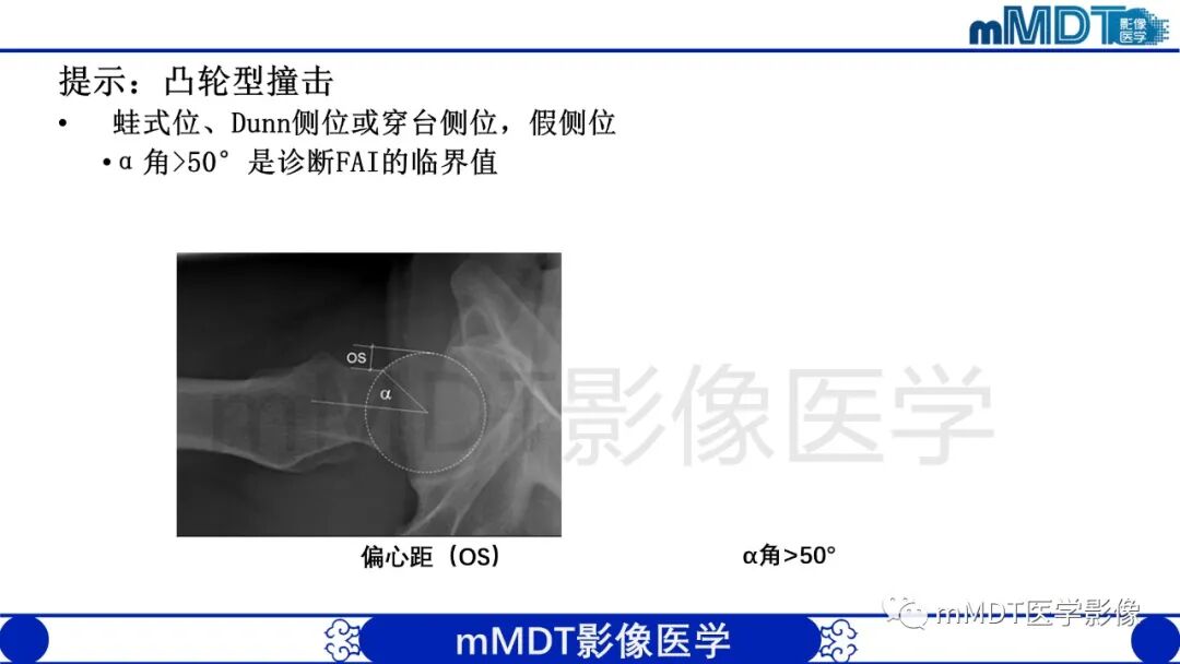 mmd在医学上什么意思股骨髋臼撞击症影像学改变_https://www.jmylbn.com_新闻资讯_第18张