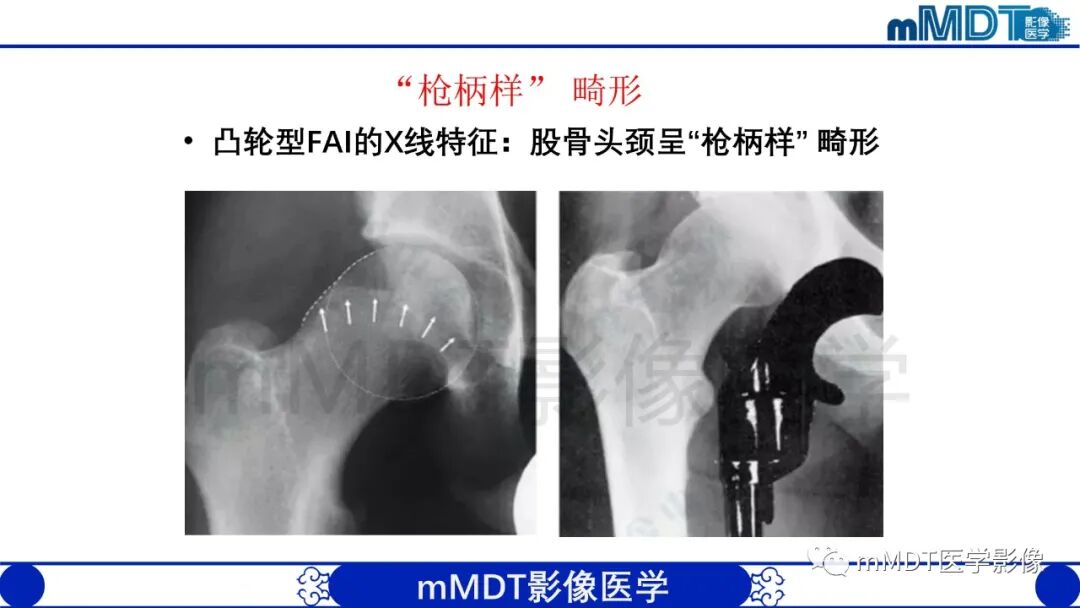 mmd在医学上什么意思股骨髋臼撞击症影像学改变_https://www.jmylbn.com_新闻资讯_第19张