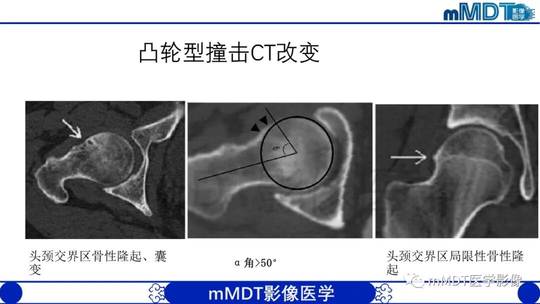 mmd在医学上什么意思股骨髋臼撞击症影像学改变_https://www.jmylbn.com_新闻资讯_第29张