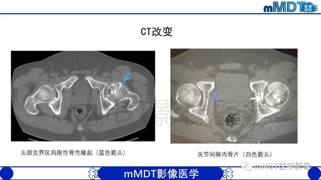 mmd在医学上什么意思股骨髋臼撞击症影像学改变_https://www.jmylbn.com_新闻资讯_第43张